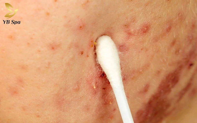 thuốc trị mụn da liễu