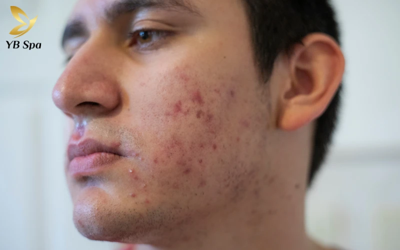 Các trường hợp nên kết hợp điều trị