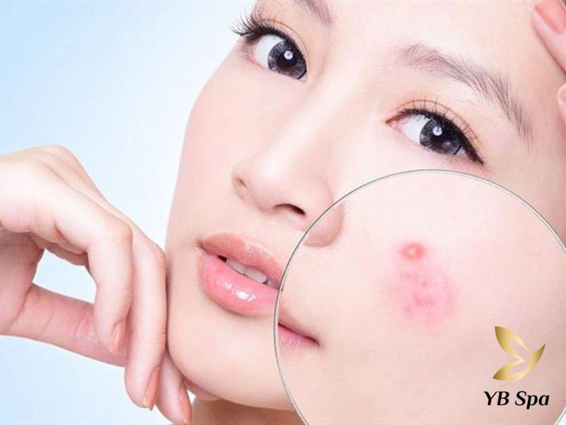 thuốc trị mụn nhọt