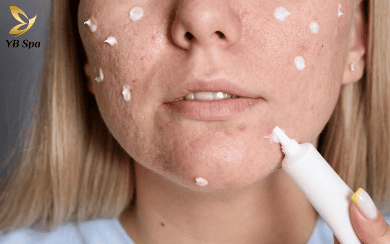 Tổng hợp 12 loại thuốc trị mụn viêm hiệu quả giúp giảm sưng đau và ngăn ngừa nguy cơ để lại sẹo rỗ tối ưu