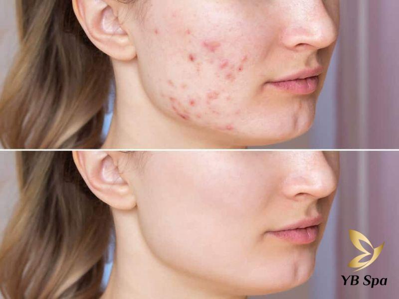 Điểm danh top 12 loại thuốc trị mụn viêm hiệu quả nhất 40 Trước và sau khi sử dụng thuốc trị mụn