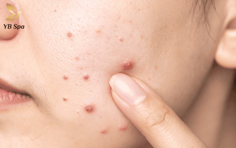 Việc tác động lực tay không vệ sinh vào nang lông đang mềm là nguyên nhân hàng đầu dẫn đến sẹo rỗ vĩnh viễn