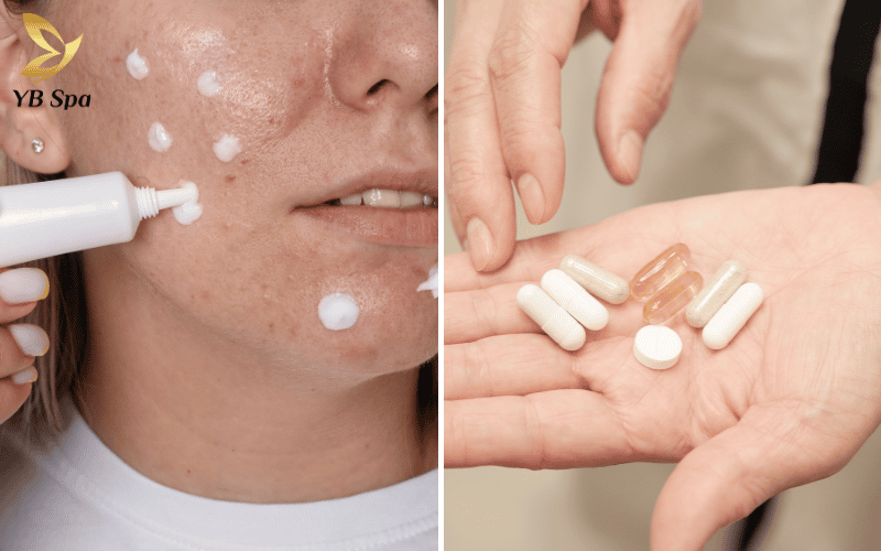 Hiểu rõ sự khác biệt giữa thuốc bôi và thuốc uống giúp bạn xây dựng lộ trình điều trị mụn viêm khoa học và hiệu quả hơn