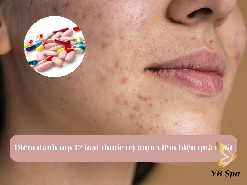 thuốc trị mụn viêm