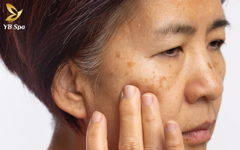 thuốc trị nám hiệu quả