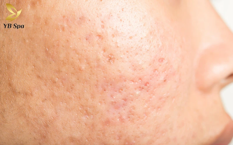 Top 6 thuốc trị sẹo hiệu quả được chuyên gia khuyên dùng 33 Sẹo mụn (Sẹo sau viêm)