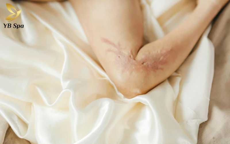 Top 6 thuốc trị sẹo hiệu quả được chuyên gia khuyên dùng 34 Sẹo do tai nạn và chấn thương