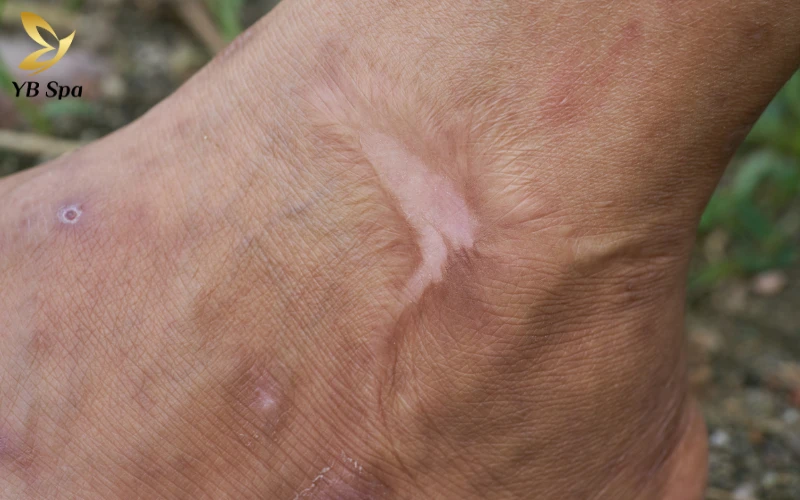 Top 6 thuốc trị sẹo hiệu quả được chuyên gia khuyên dùng 36 Sẹo bỏng