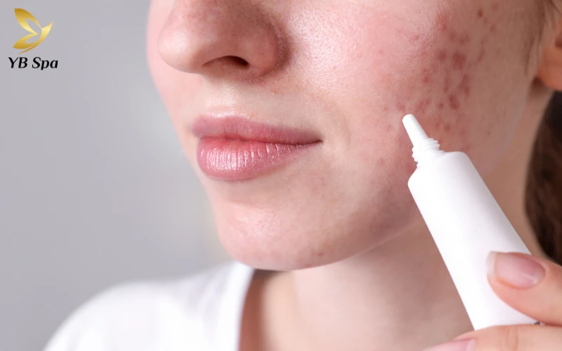 Top 6 thuốc trị sẹo hiệu quả được chuyên gia khuyên dùng 37 Tối ưu hóa hiệu quả điều trị