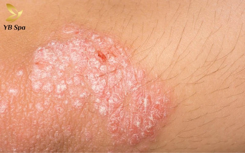 Cách tỉa lông vùng kín nữ bằng kéo an toàn, tránh ngứa 16 Trì hoãn việc tỉa lông khi vùng kín có dấu hiệu viêm nhiễm để ngăn chặn sự lây lan vi khuẩn sang các vùng da lành