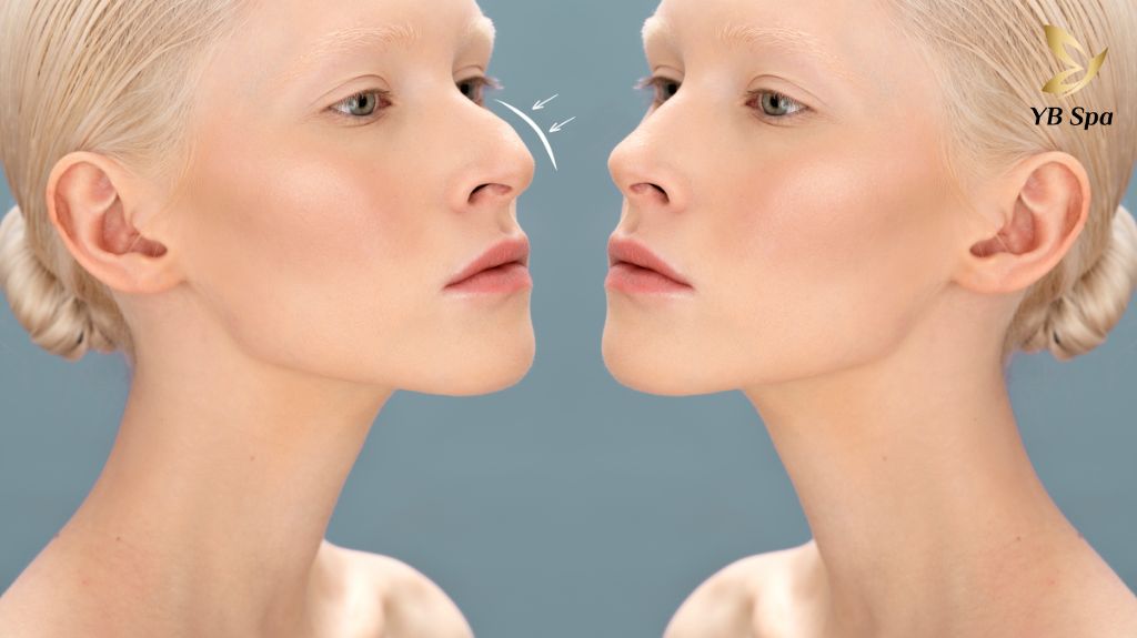 Tìm hiểu về tiêm Filler làm đầy - Phương pháp tạo hình thẩm mỹ hiện đại 16 Tiem Filler Lam Day 3