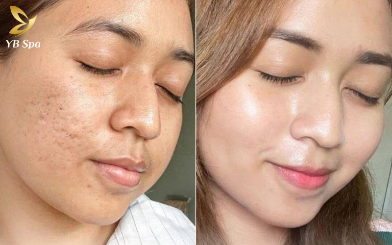 Tiêm meso bao lâu 1 lần? Yếu tố quyết định khoảng cách giữa 2 lần tiêm 10 Hãy kiên trì đến buổi thứ 3 của liệu trình để thấy được sự bứt phá ngoạn mục về độ sáng và sức sống của làn da