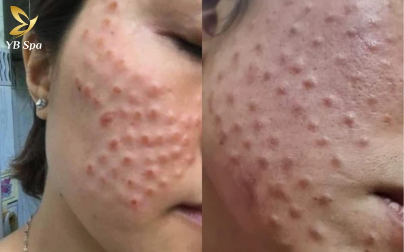 Tiêm meso bao lâu 1 lần? Yếu tố quyết định khoảng cách giữa 2 lần tiêm 14 Khi da bị "quá tải" bởi lượng hoạt chất cũ chưa kịp hấp thụ, cơ thể sẽ tự động nhận diện đó là vật thể lạ và hình thành các khối u hạt đỏ cứng