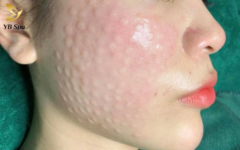 Hiện tượng sẩn hạt (papules) tại điểm tiêm là dấu hiệu cho thấy dưỡng chất đang được lưu giữ đúng vị trí để nuôi dưỡng da