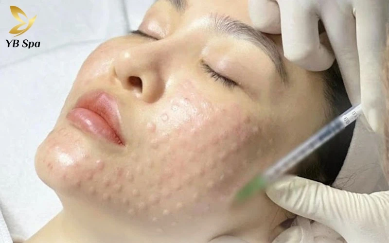 Tiêm meso bao lâu thì tan nốt sần? Timeline chi tiết và cách phân biệt với biến chứng 11 Hiểu rõ timeline phục hồi chuẩn y khoa giúp bạn yên tâm chờ đợi làn da phẳng mịn và chủ động nhận diện sớm các dấu hiệu biến chứng