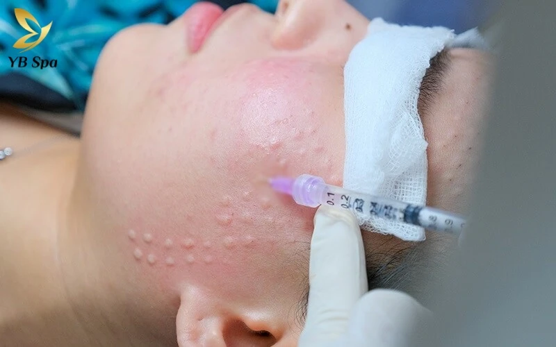 Trong 6 giờ đầu, các nốt sần sẽ hiện rõ như hạt gạo do hoạt chất vừa được đưa vào tầng trung bì và chưa kịp phân tán