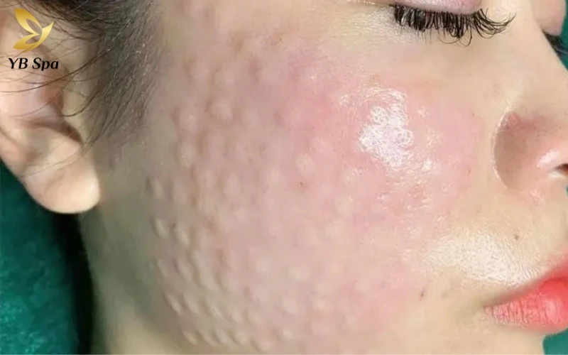 Tiêm meso bao lâu thì tan nốt sần? Timeline chi tiết và cách phân biệt với biến chứng 16 Tốc độ tan nốt sần phụ thuộc lớn vào khả năng chuyển hóa và hấp thụ dưỡng chất riêng biệt của mỗi cơ địa