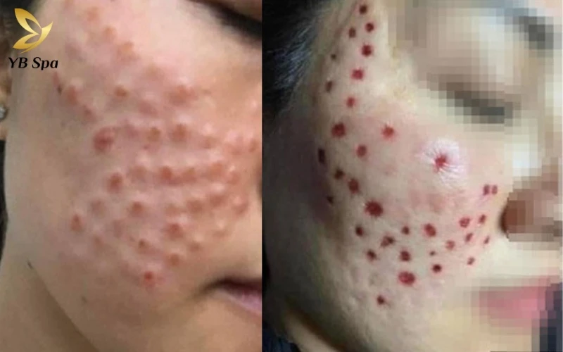 Tiêm meso bao lâu thì tan nốt sần? Timeline chi tiết và cách phân biệt với biến chứng 18 Khi nốt sần đi kèm tình trạng viêm đỏ và đau nhức không thuyên giảm, đó chính là dấu hiệu của biến chứng nguy hiểm thay vì phản ứng sinh lý