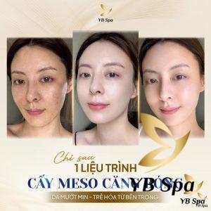 Làm Meso Có Đau Không