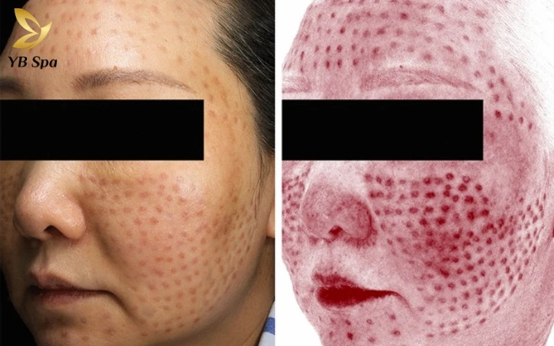 Tiêm Meso sai tầng da hoặc dùng tinh chất kém chất lượng là nguyên nhân hàng đầu dẫn đến u hạt và những nốt sần cứng cực kỳ khó điều trị.