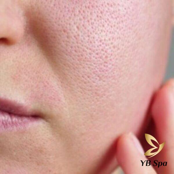 Tiêm meso se khít lỗ chân lông