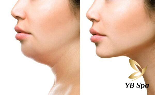 Tiêm meso tan mỡ đem đến hiệu quả nhanh chóng (Nguồn: Internet)