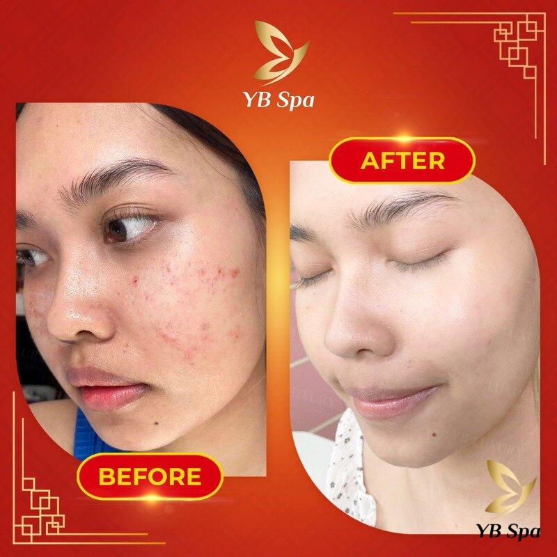 Meso Thu Nhỏ Lỗ Chân Lông: Giải Pháp Cho Làn Da Mịn Màng, Rạng Rỡ 16 Hiệu quả sau một lần tiêm meso tại YB Spa (Nguồn: YB Spa)