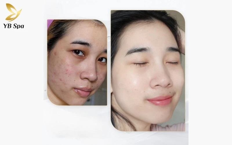 Tiêm Meso trị mụn có hiệu quả không? 5 Lưu ý sau tiêm để đạt hiệu quả tốt nhất 23 Liệu trình Meso được thiết kế riêng biệt cho từng tình trạng da, đảm bảo xử lý trúng đích cả mụn ẩn lẫn mụn viêm