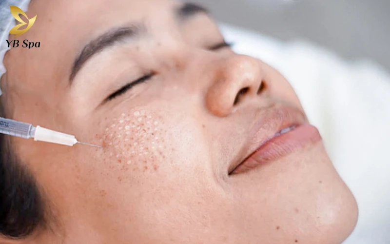 Mesotherapy là kỹ thuật sử dụng kim siêu nhỏ để dẫn truyền trực tiếp các dưỡng chất vào sâu lớp trung bì của da