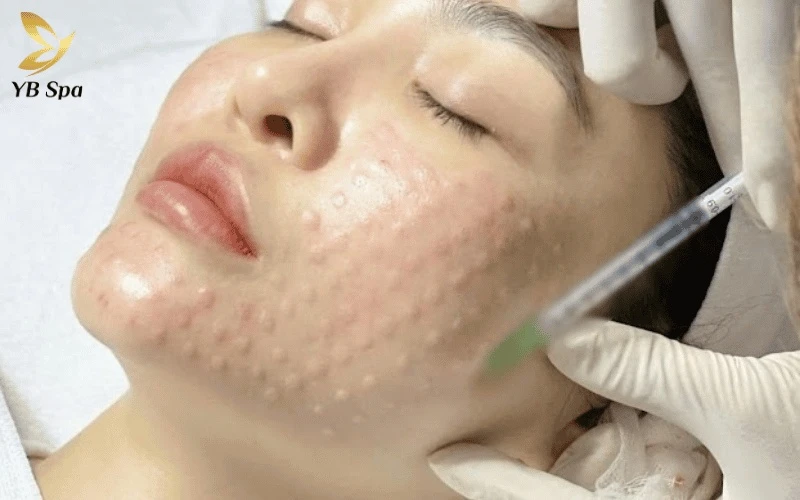 Tiêm Meso Trị Nám Có Tác Dụng Phụ Không? 14 Tình trạng sưng đỏ nhẹ là dấu hiệu tích cực cho thấy các mao mạch đang hoạt động mạnh mẽ để đưa tinh chất đi nuôi dưỡng tế bào