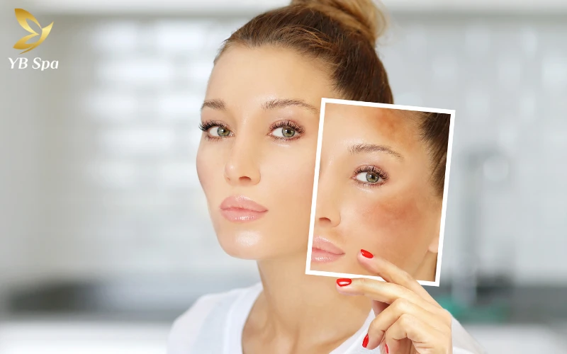 Thay vì xóa sổ hoàn toàn, mục tiêu của Meso là kiểm soát và ức chế gốc nám một cách tối ưu nhất.