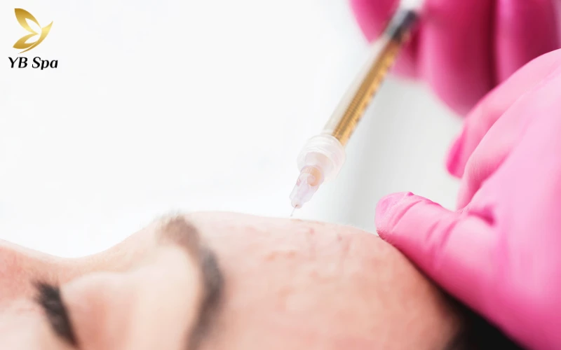 Kỹ thuật tiêm Meso chuẩn xác ở độ sâu 1mm - 4mm là yếu tố then chốt giúp dưỡng chất trị nám phát huy tác dụng tối ưu