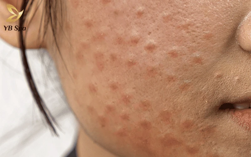 Tiêm Meso Trị Nám Có Tác Dụng Phụ Không? 16 Nếu những nốt sần sau tiêm không biến mất sau vài ngày mà trở nên cứng và nổi gồ, đó chính là dấu hiệu của biến chứng u hạt nguy hiểm