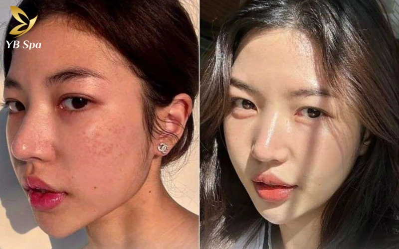 Tiêm Meso không chỉ giúp mờ nám mà còn mang lại làn da căng mọng nhờ sự kết hợp hoàn hảo giữa HA và Peptide