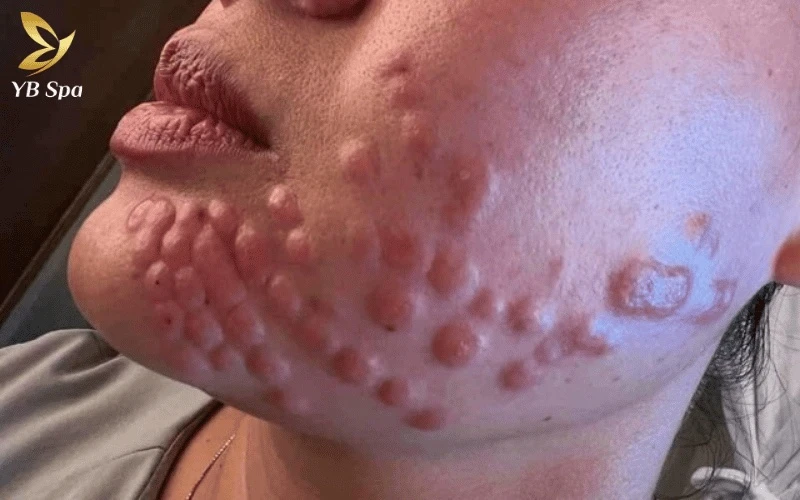 Tiêm Meso Trị Nám Có Tác Dụng Phụ Không? 17 Hãy cảnh giác nếu các điểm tiêm không dịu đi mà ngày càng sưng to, vì đó là biểu hiện của tình trạng nhiễm khuẩn da đáng báo động