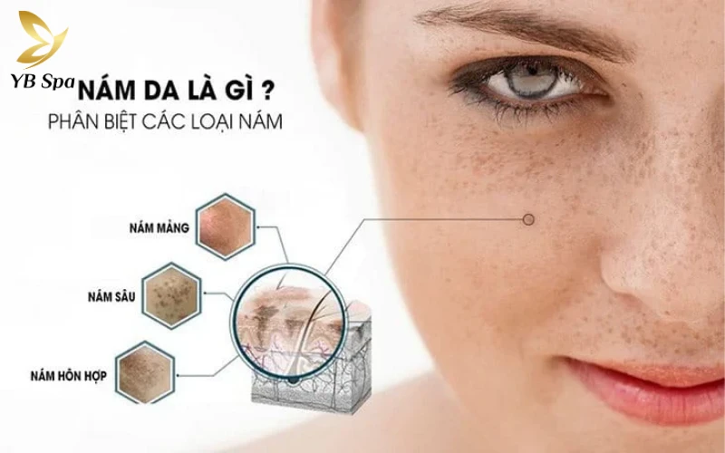 Việc xác định chính xác loại nám (mảng, sâu hay hỗn hợp) quyết định đến 90% thành công của liệu trình tiêm Meso