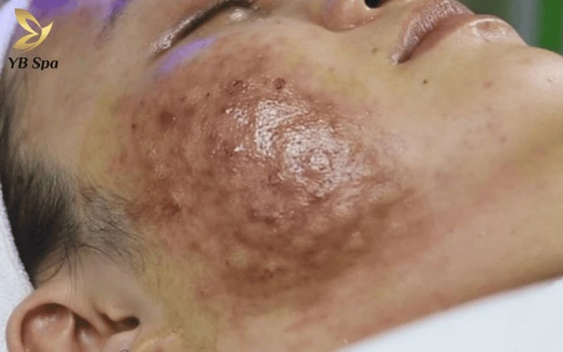 Tiêm Meso Trị Nám Có Tác Dụng Phụ Không? 18 Hãy đặc biệt lưu tâm nếu vùng tiêm xuất hiện mảng tím đen hoặc mất cảm giác, vì đây là dấu hiệu cảnh báo hoại tử da cực kỳ nguy hiểm