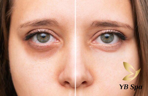 Tiêm meso trị thâm quầng mắt