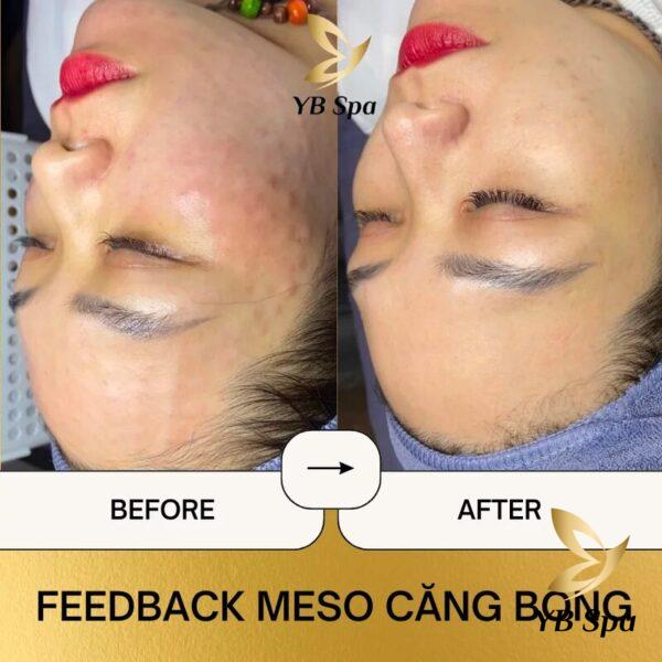 Trước và sau khi tiến hành phương pháp tiêm meso căng bóng tại YB Spa (Nguồn: YB Spa)