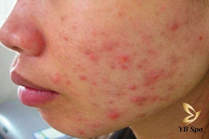 Tiêu diệt các ổ mụn viêm bằng cách nào? Điều trị ở đâu uy tín? 18 Ổ mụn viêm trên mặt