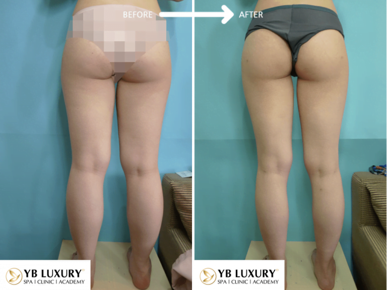 Phương pháp giảm mỡ toàn thân HIỆU QUẢ không phẫu thuật 24 Toanthan1 768x575