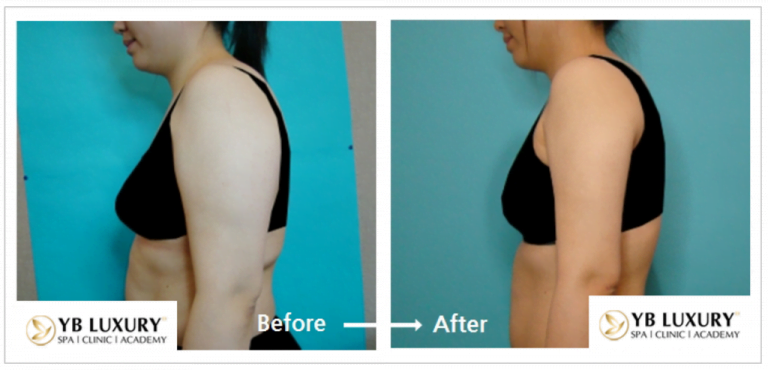 Phương pháp giảm mỡ toàn thân HIỆU QUẢ không phẫu thuật 26 Toanthan3 768x370