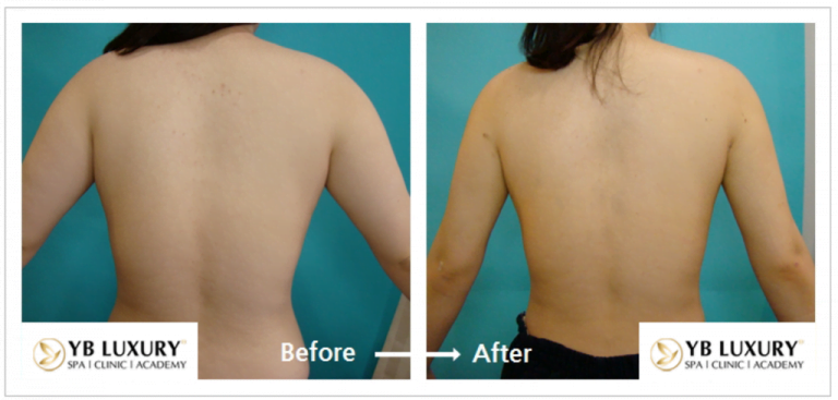 Phương pháp giảm mỡ toàn thân HIỆU QUẢ không phẫu thuật 27 Toanthan4 768x367