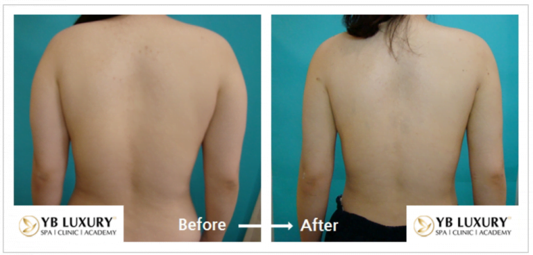 Phương pháp giảm mỡ toàn thân HIỆU QUẢ không phẫu thuật 28 Toanthan5 768x367