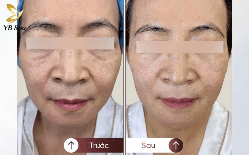 Diện mạo trẻ trung và làn da căng mịn của khách hàng ngay sau 1 liệu trình LinearZ tại YB Spa