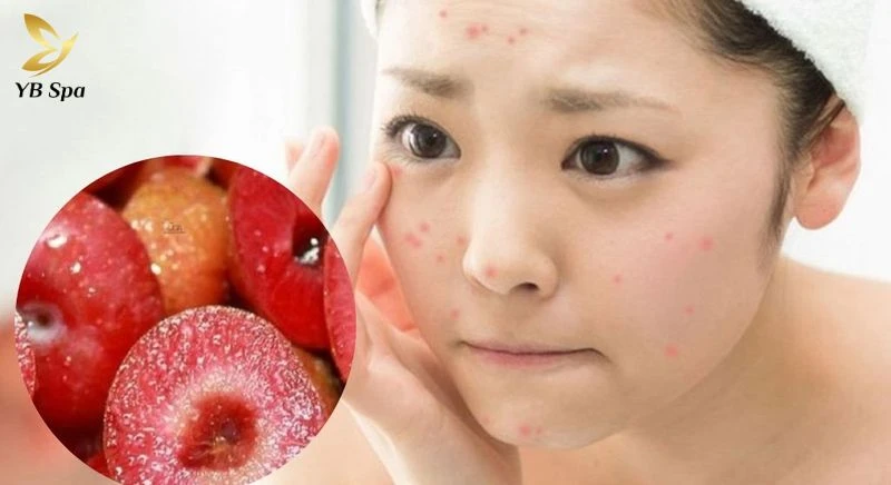 Tránh ăn khi đang bị mụn viêm nặng