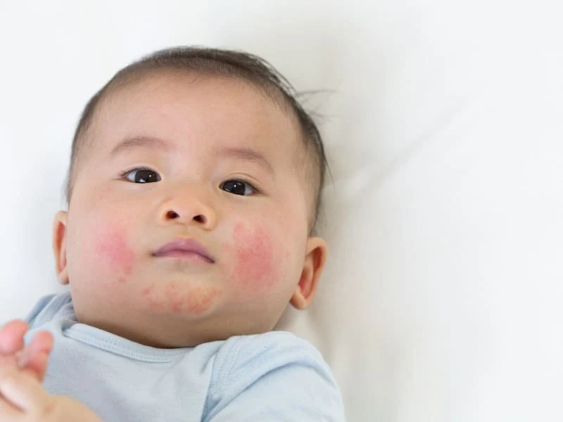 Trẻ bị nổi mụn nước khắp người là dấu hiệu bệnh gì? 8 Mặt trẻ em bị nổi mụn nước