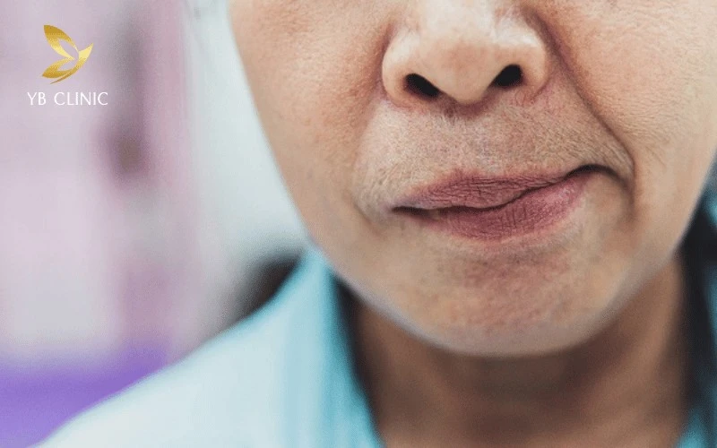 Trẻ Hóa Da Bằng Hifu: Ưu Điểm Và Nhược Điểm 10 Thực hiện HIFU sai kỹ thuật có thể gây tổn thương dây thần kinh mặt hoặc bỏng nhiệt.