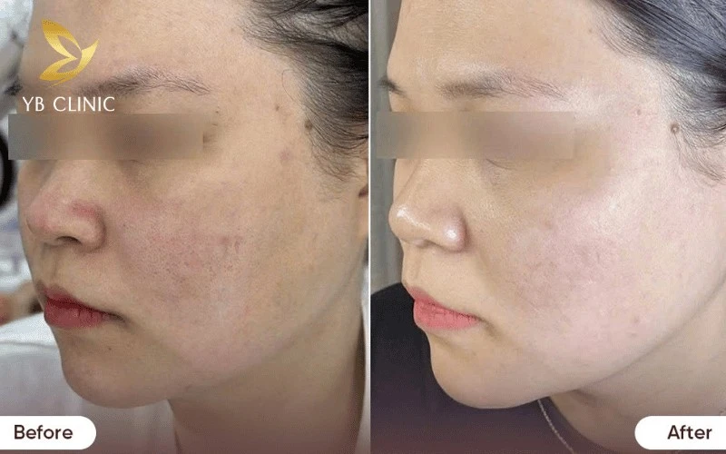 Trẻ Hóa Da Bằng Laser Có Tốt Không? Ưu Điểm Và Nhược Điểm 10 Laser Chrome ứng dụng bước sóng chọn lọc hỗ trợ tác động vào melanin gây nám và sắc tố mà vẫn hạn chế ảnh hưởng nền da xung quanh
