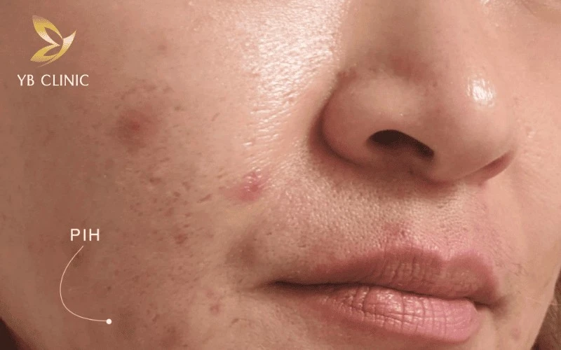 Trẻ Hóa Da Bằng Laser Có Tốt Không? Ưu Điểm Và Nhược Điểm 12 Tăng sắc tố sau viêm là rủi ro phổ biến của phương pháp trẻ hóa da bằng Laser đối với tuýp da người châu Á.